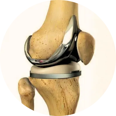 Partial Joint Replacement
