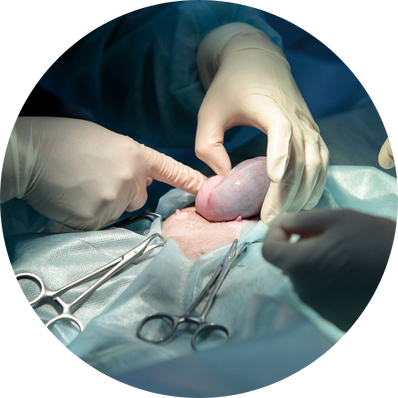 Open (Laparotomy) Cystectomy