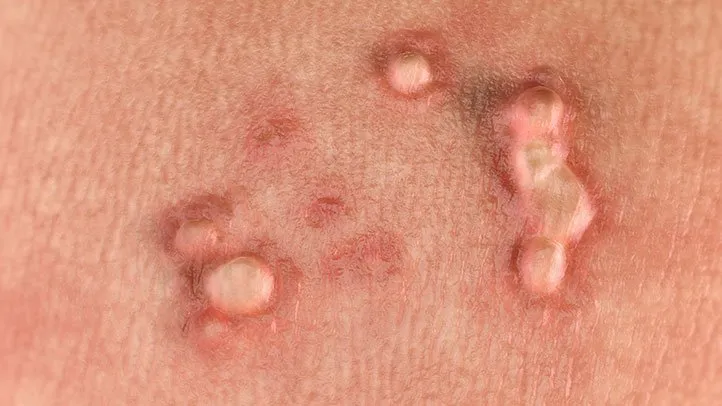 Genital Warts at Healic