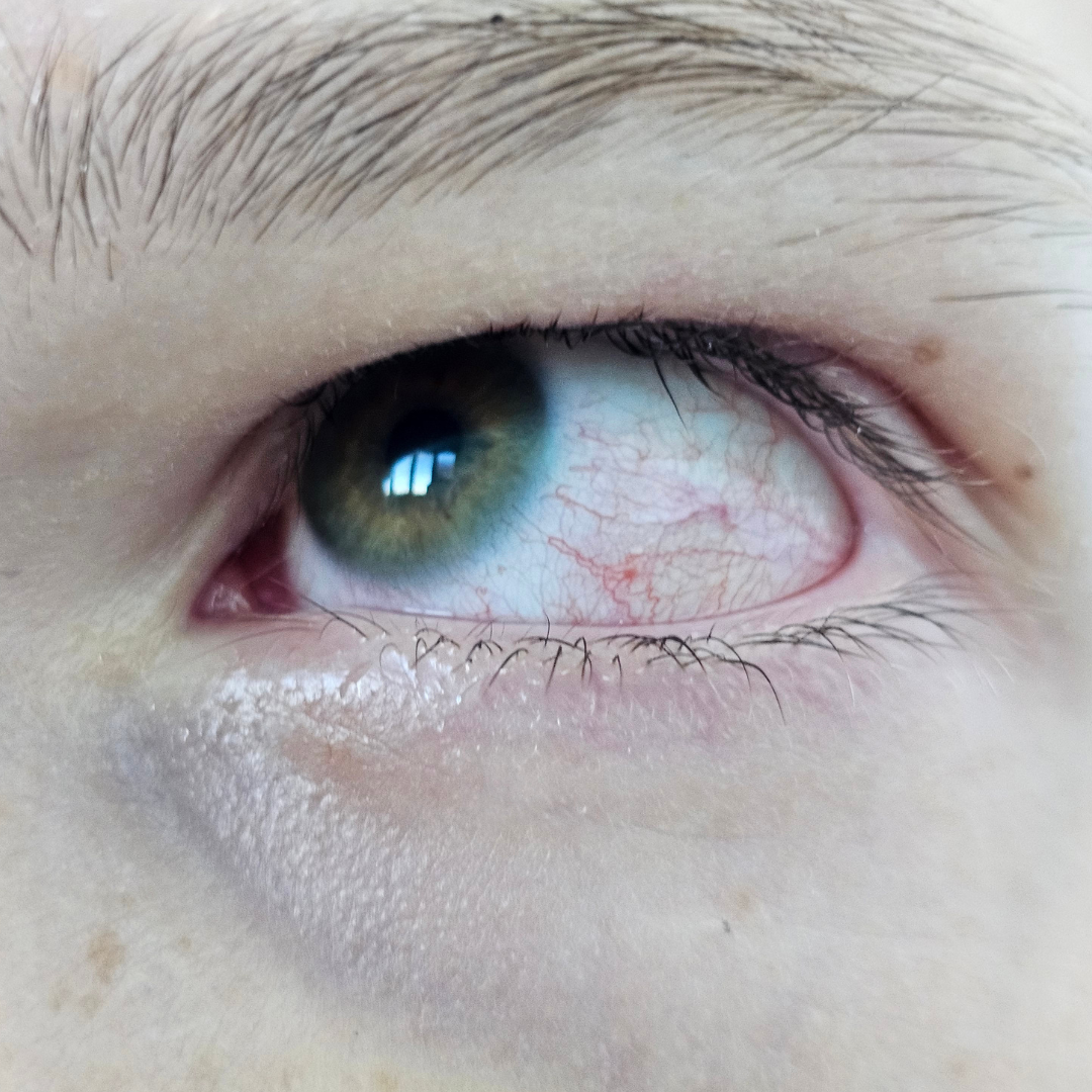 Severe corneal opacity or white scar
