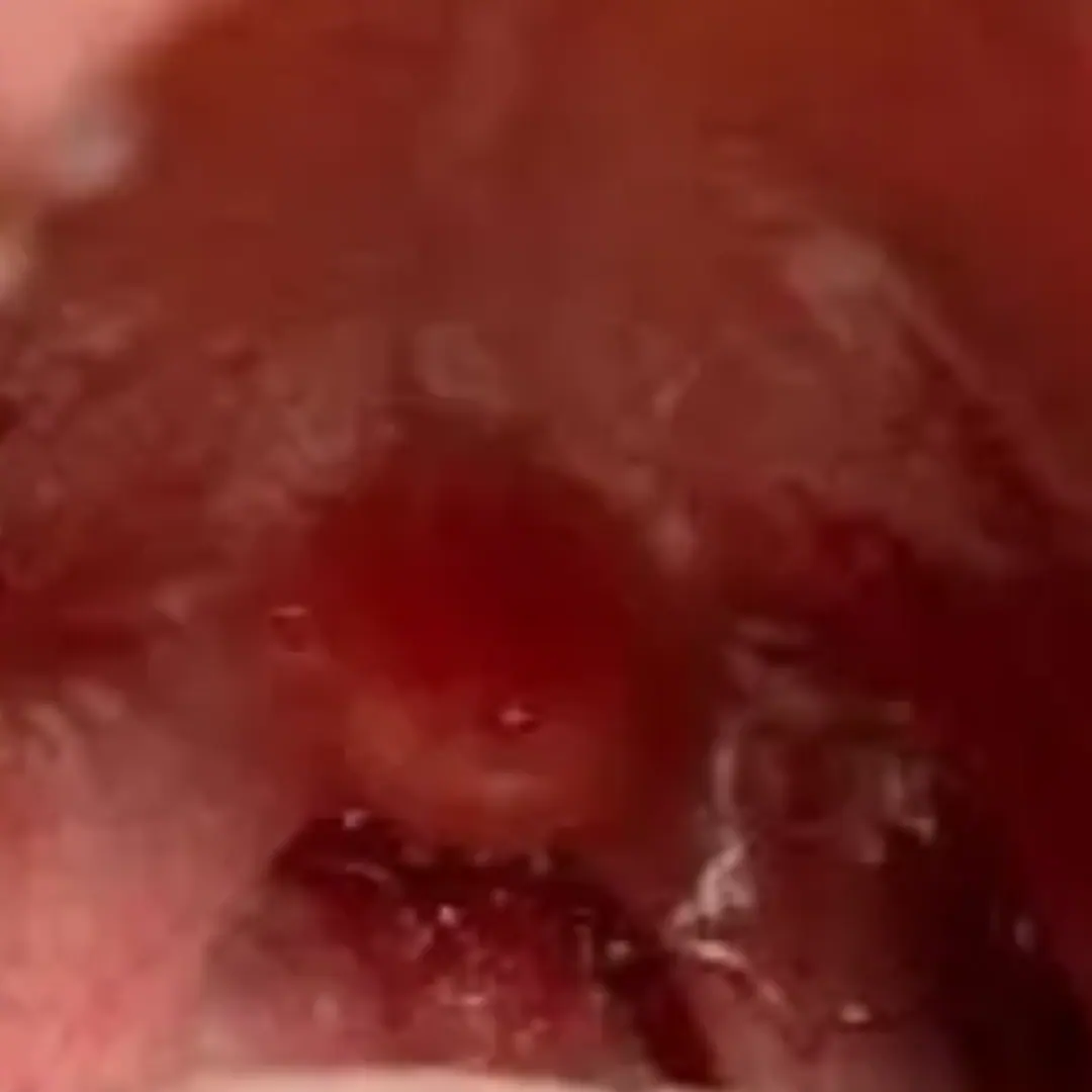 Difficulty swallowing due to enlarged tonsils