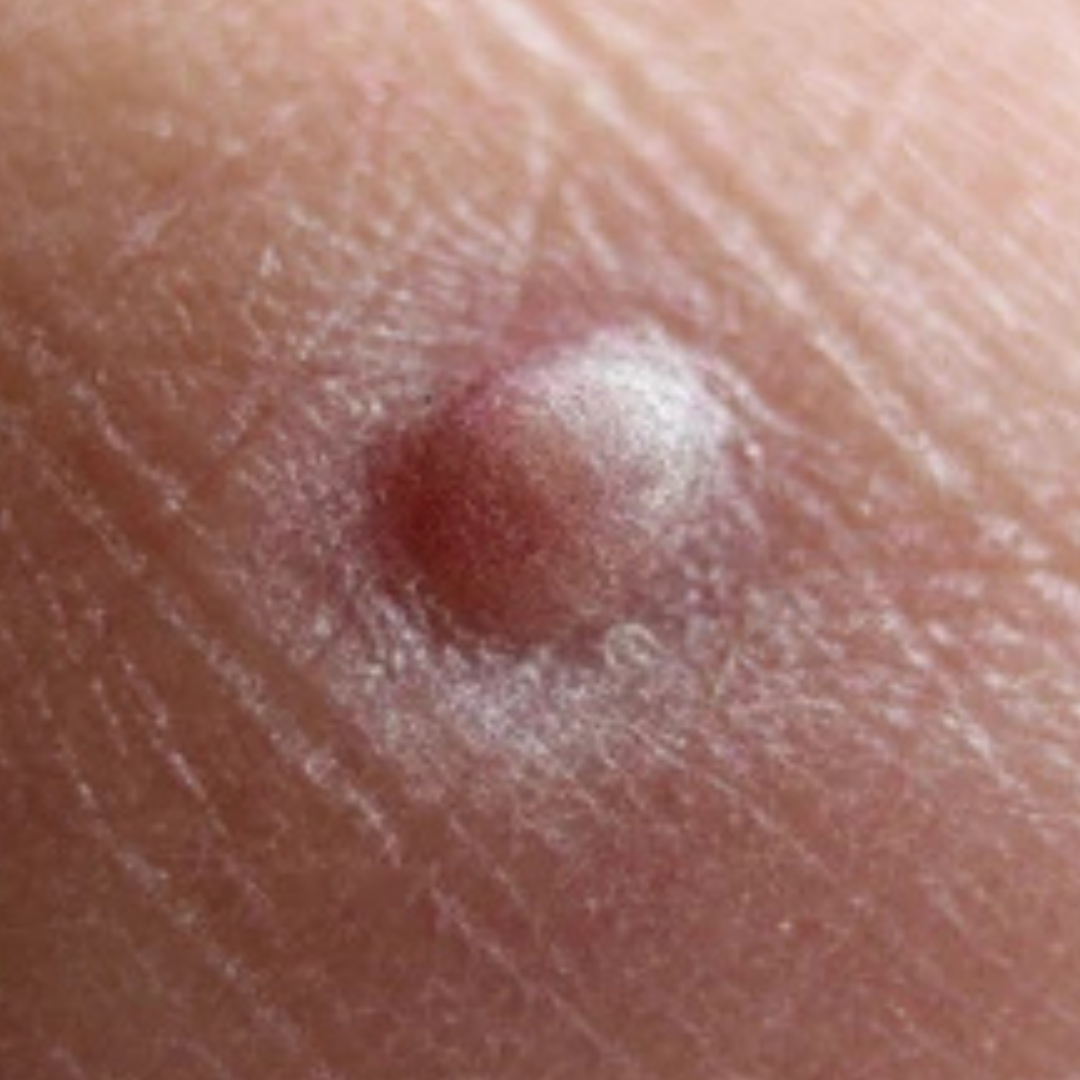 Presence of a soft, rubbery lump under the skin