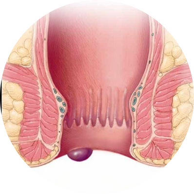 External Haemorrhoids
