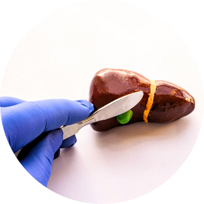 Open Cholecystectomy