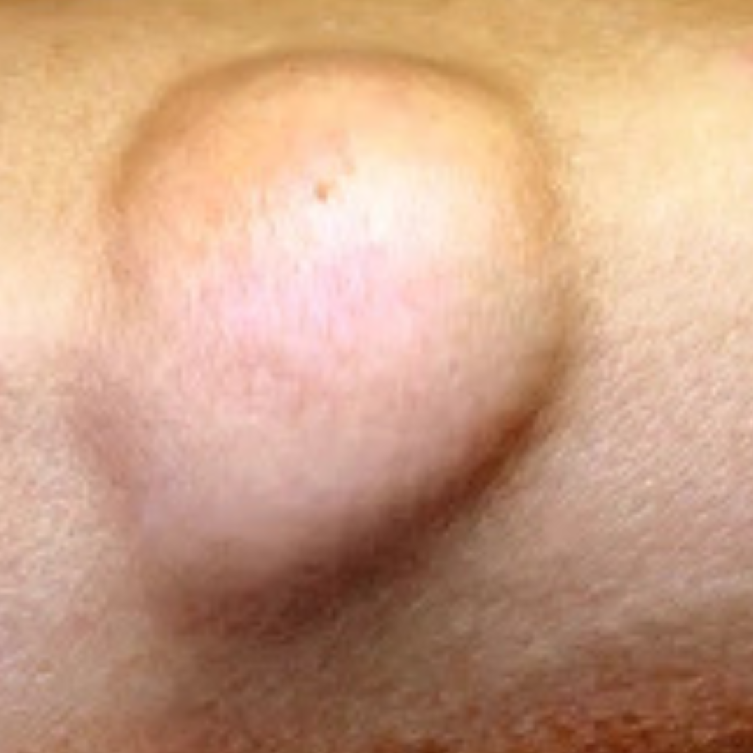 Cosmetic concerns due to visible bulge