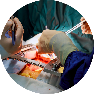 Open Release Surgery