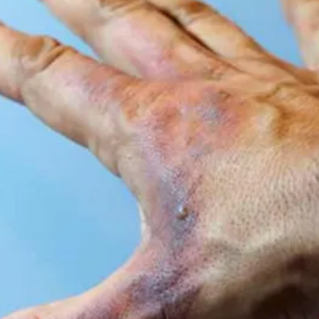 Severe burns or traumatic injuries with tissue death