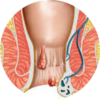 Thrombosed Haemorrhoid