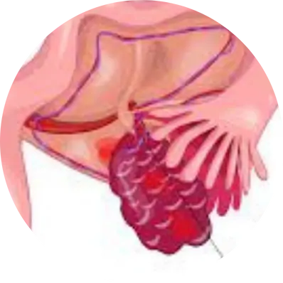 Sudden severe pain (ovarian torsion)