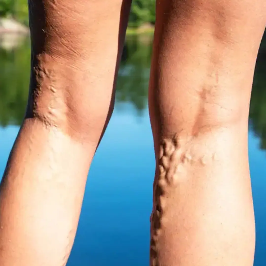 Twisted, swollen, or lumpy veins