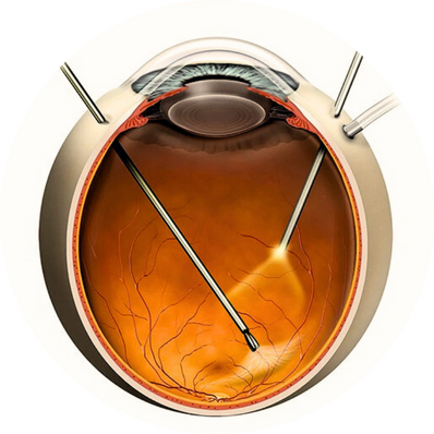 Anterior vitrectomy