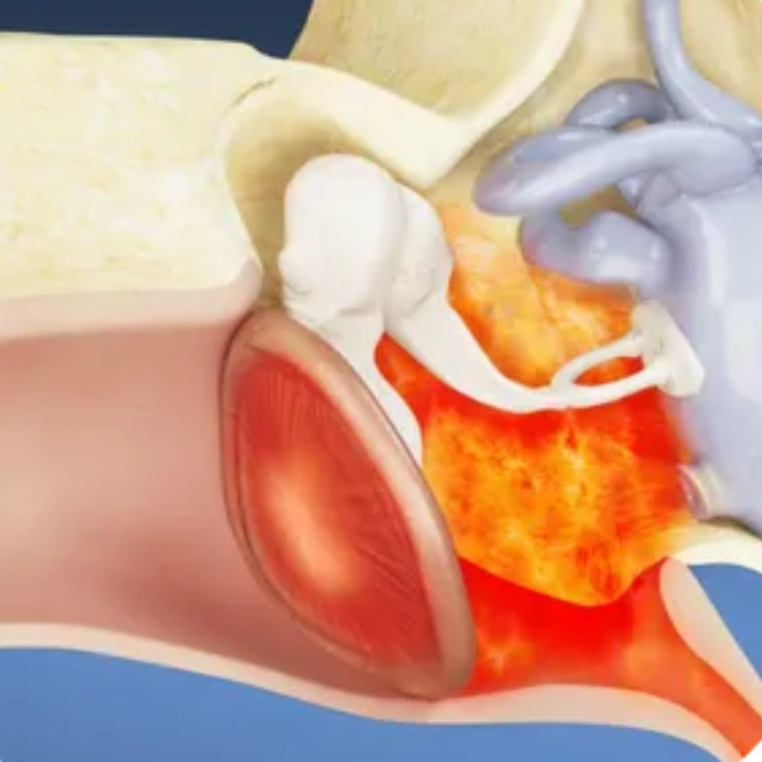 Recurrent ear infections