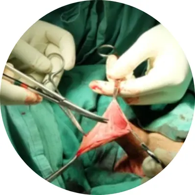 Conventional Surgical Circumcision