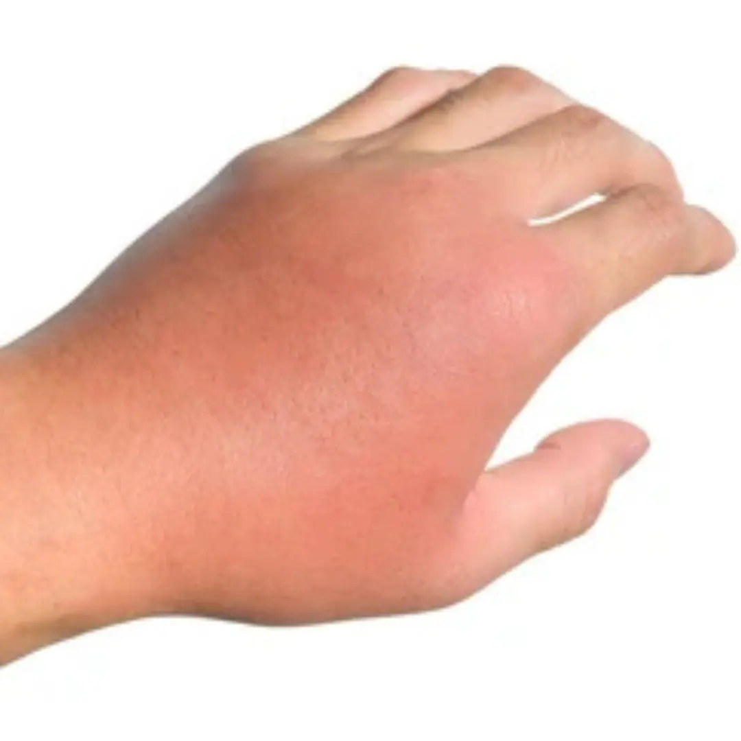 Swelling or deformity of the joint