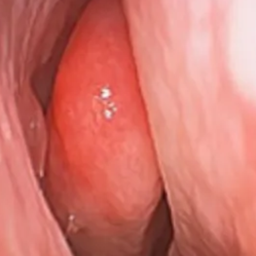 Headaches or facial pain due to blocked sinuses