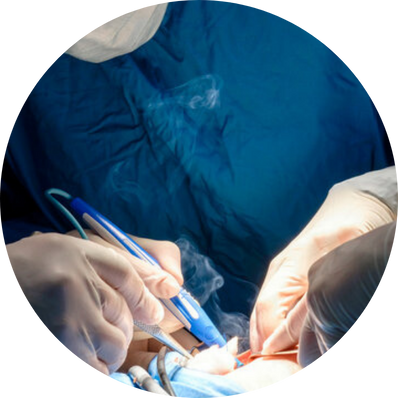 Electrocautery tonsillectomy