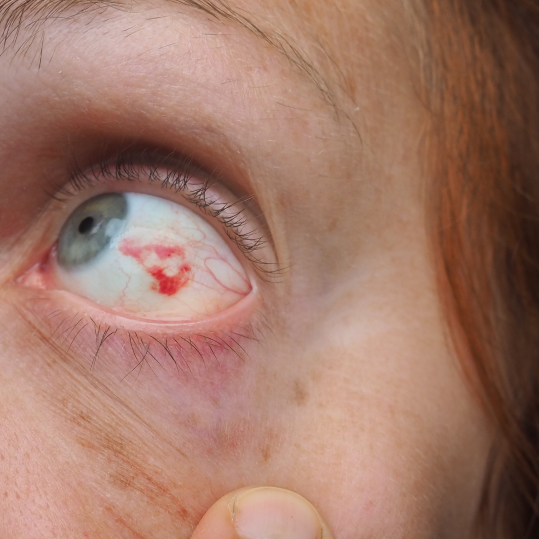 Vitreous bleeding in diabetes