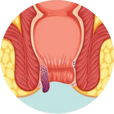 Internal Haemorrhoids