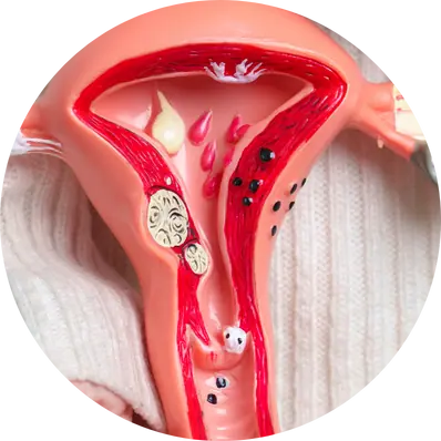 Total hysterectomy