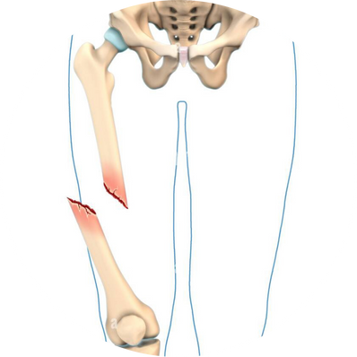 Open fracture