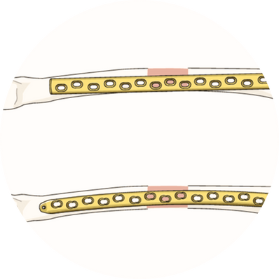 Dynamic Compression Plate (DCP) / LCP