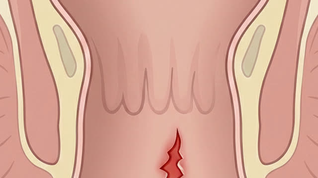 Anal fissure — symptoms and treatment