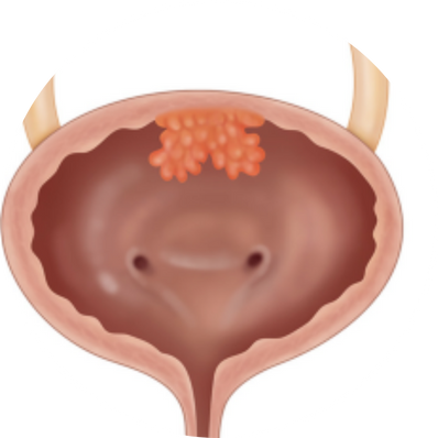 Partial Cystectomy