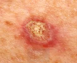 Precancerous conditions