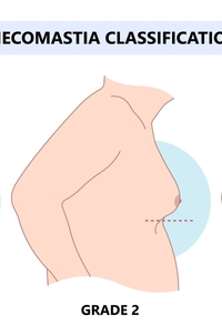 Adult Gynecomastia