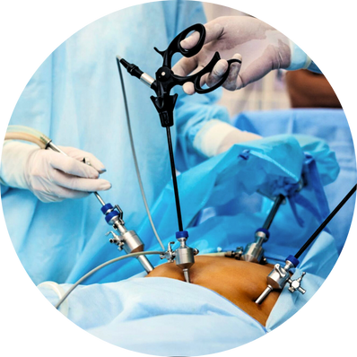 Laparoscopic Cholecystectomy