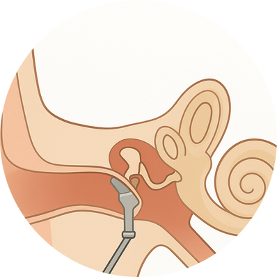 Replacement of ossicles