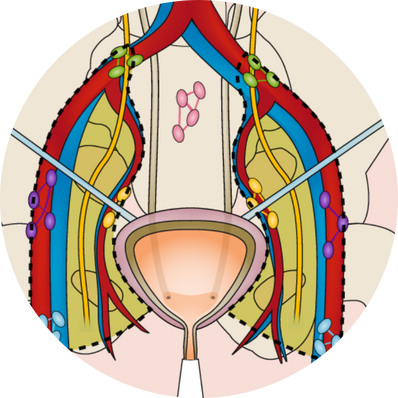 Radical Cystectomy