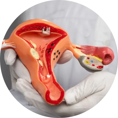 Bilateral Cystectomy